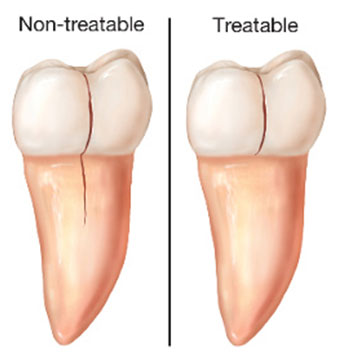 Dental Crown Centennial Colorado