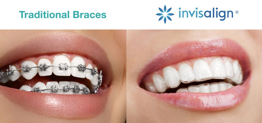 Invisalign Centennial Colorado