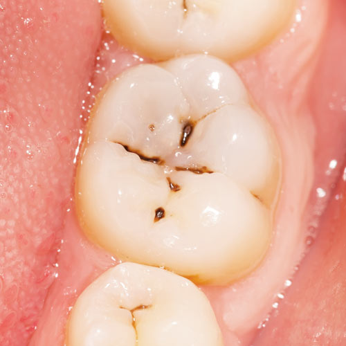 Small cavity deals in molar