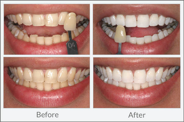 Teeth whitening can dramatically improve the cosmetics of your smile.