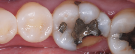 Dental crowns are a cosmetic way to replace the old filling.