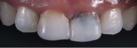 Dental crowns can significantly improve the cosmetics of teeth