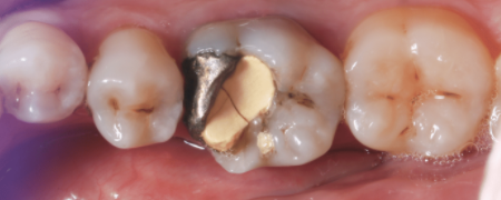 Dental crowns restore a tooth that has been broken or cracked