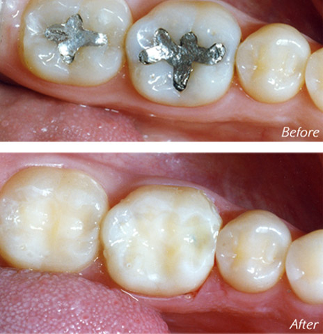 Mercury Filling Removal Before and After
