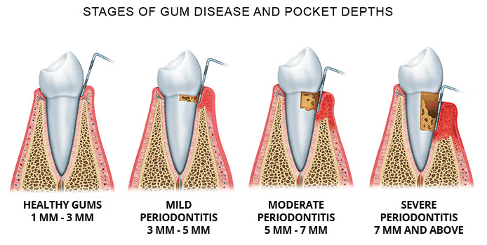 Periodontal probings and periodontal disease