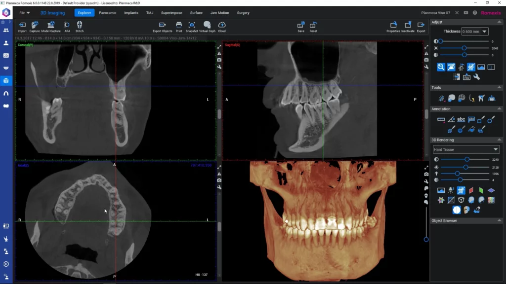 CBCT Image For Implant Planning