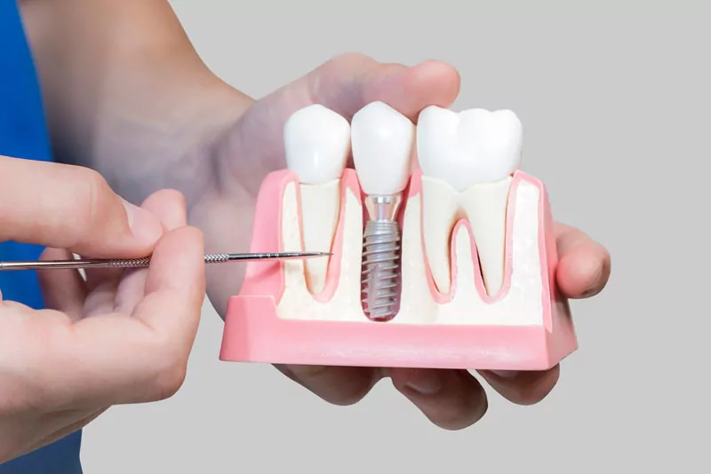 Are Dental Implants Right For Me