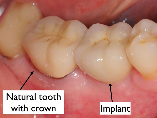 Dental Implant Delivered to Patient