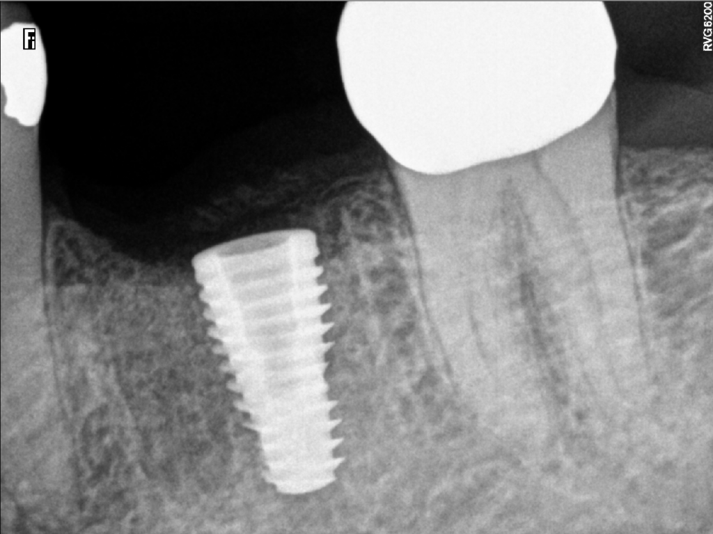 Do Dental Implants Hurt