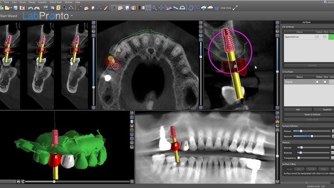 Implant Scanning Software With Digital Scan and CBCT Loaded