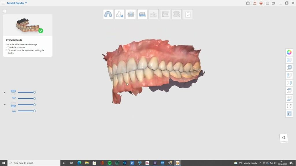 Digital Scan File In Preparation of Dental Implant