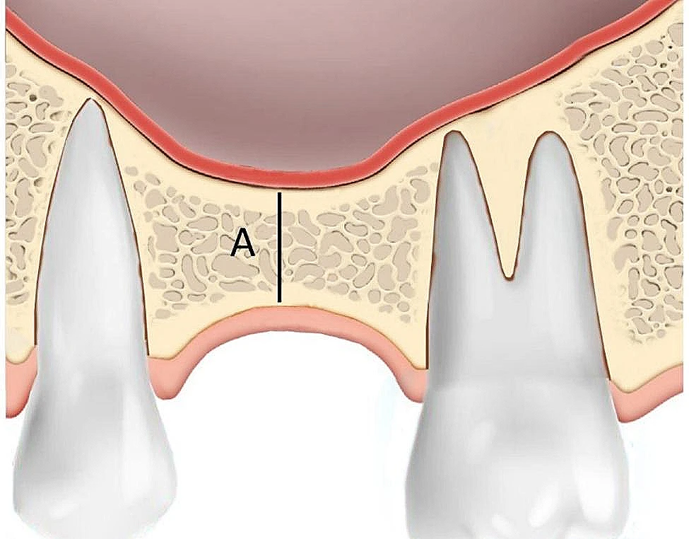 Are Dental Implants Right For Me