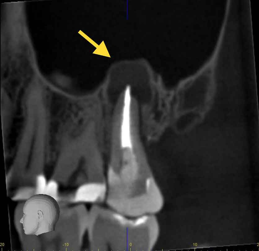 Infected tooth found using CBCT Imaging