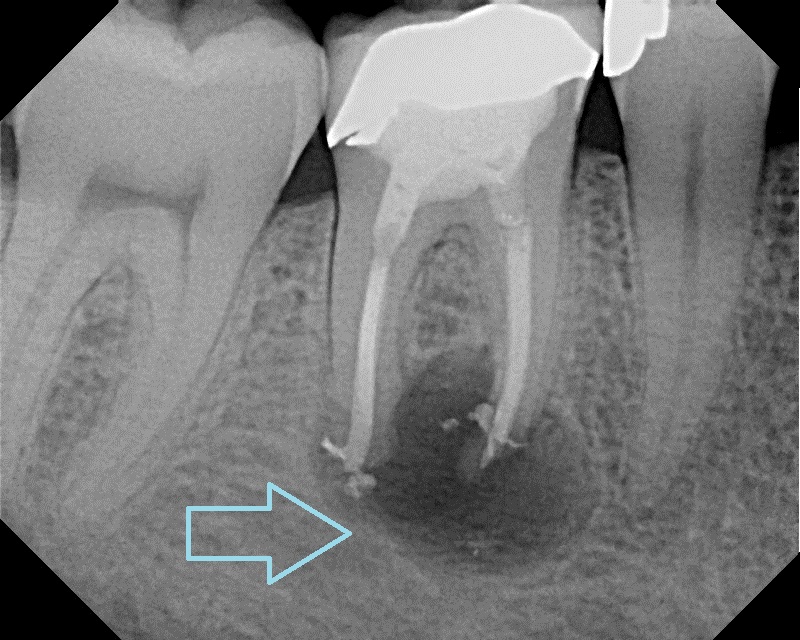 Infected Molar Found Furing CBCT Imaging and Evaluation