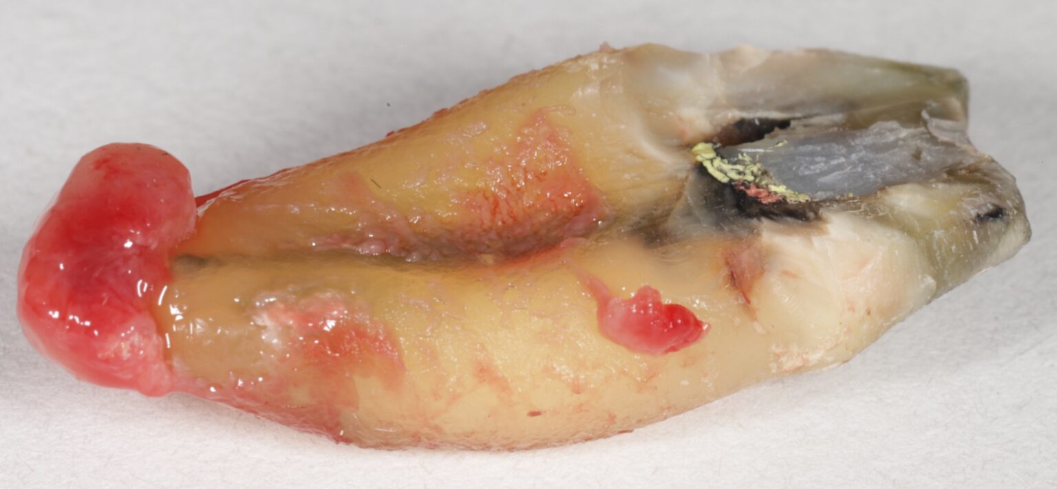 What Does an Infected Root Canal Look Like? - Jeffrey S. Tatarin DDS